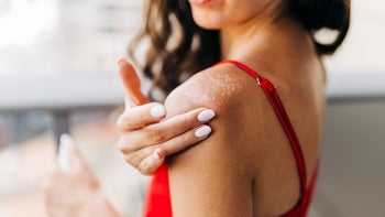 dermatology: closeup woman applying moisturizer on sunburn 1399751197