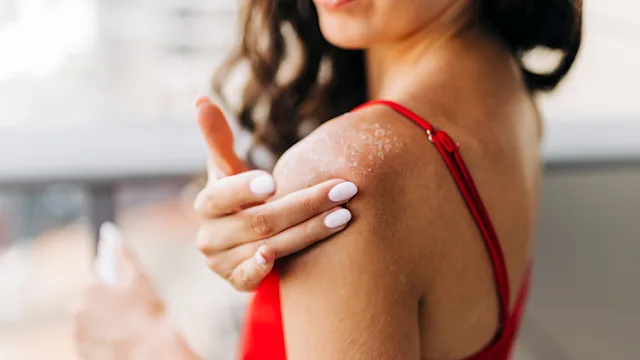 dermatology: closeup woman applying moisturizer on sunburn 1399751197