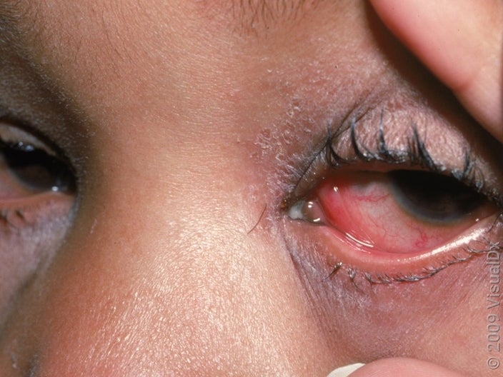 Conjunctivitis causes redness of the eye and tearing.