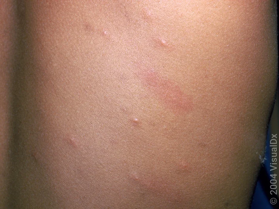 A close-up look at an early chickenpox rash. 