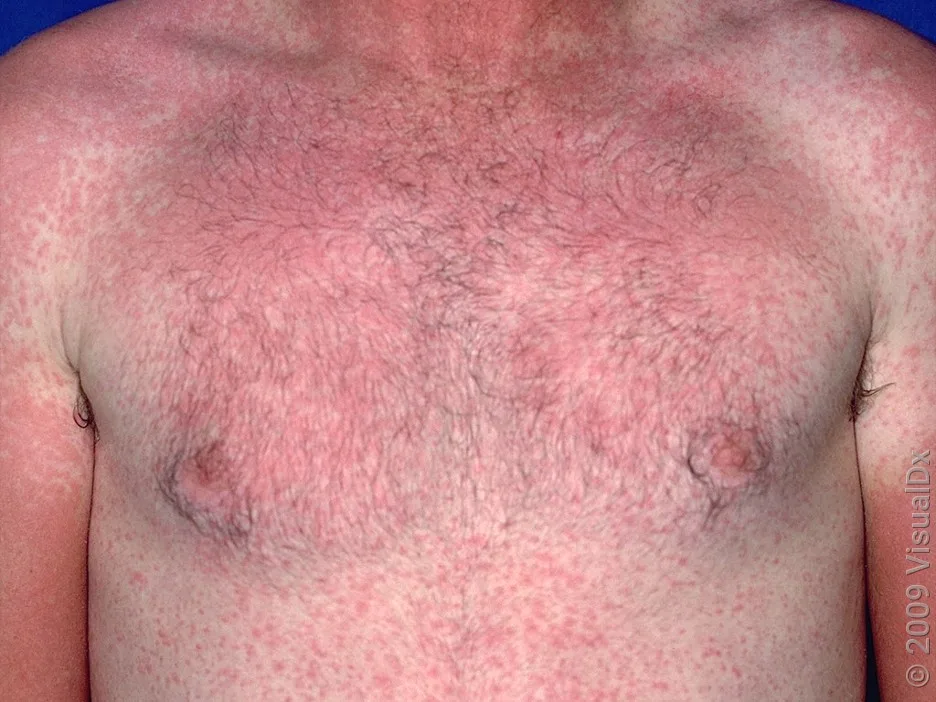 An exanthematous drug rash on the chest and arms. 