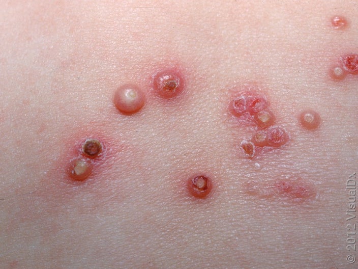 As molluscum contagiosum heals, red or brown marks (like on the bottom right) can remain. These eventually fade. 
