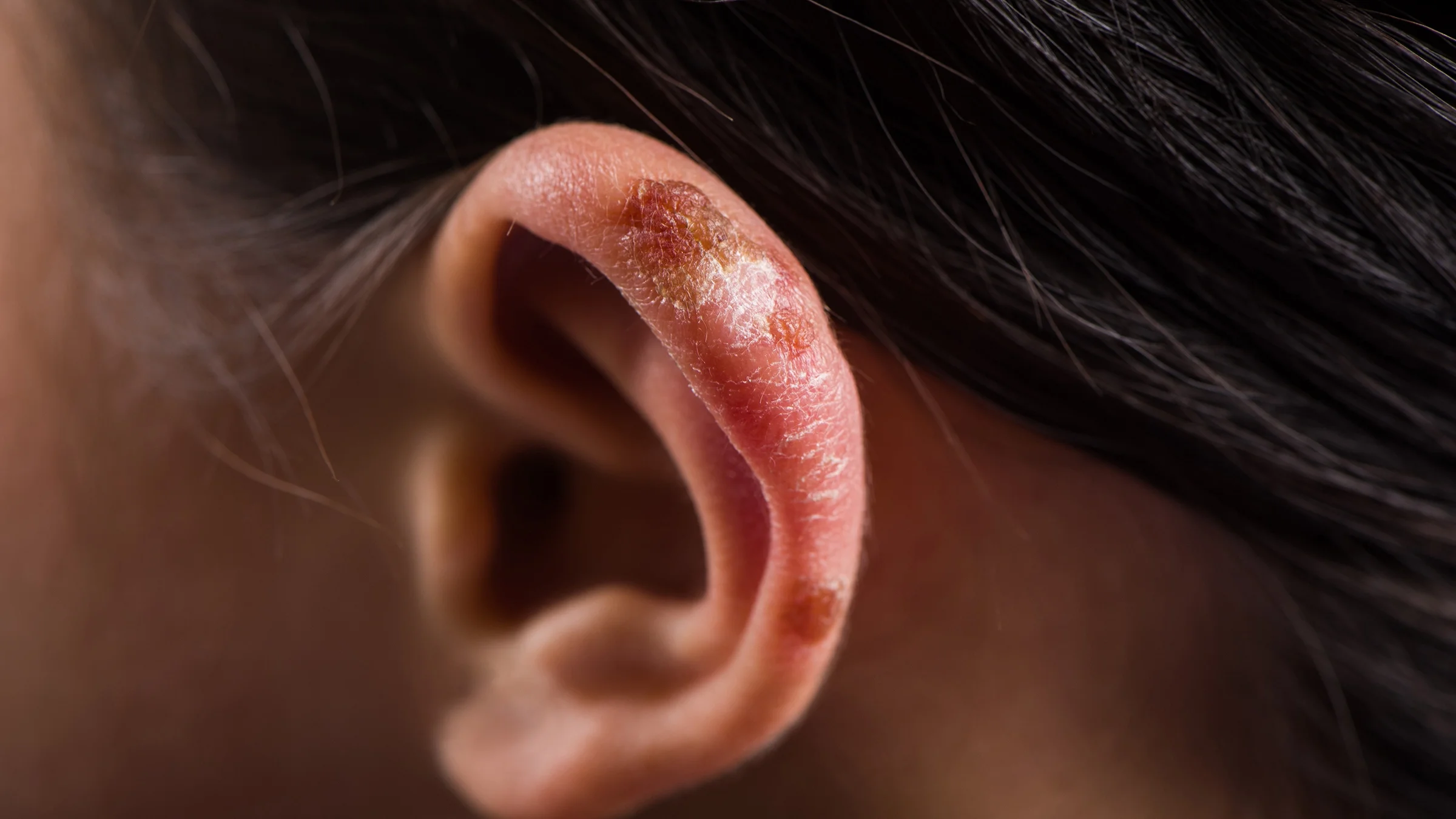 A person’s ear has chilblains.