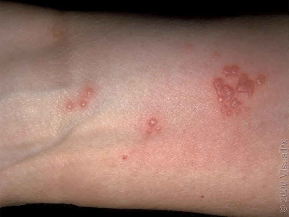 Close-up of the shingles rash on the arm. 