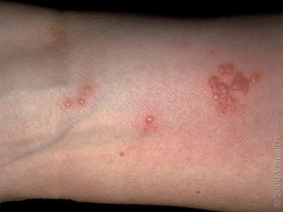 Close-up of the shingles rash on the arm. 