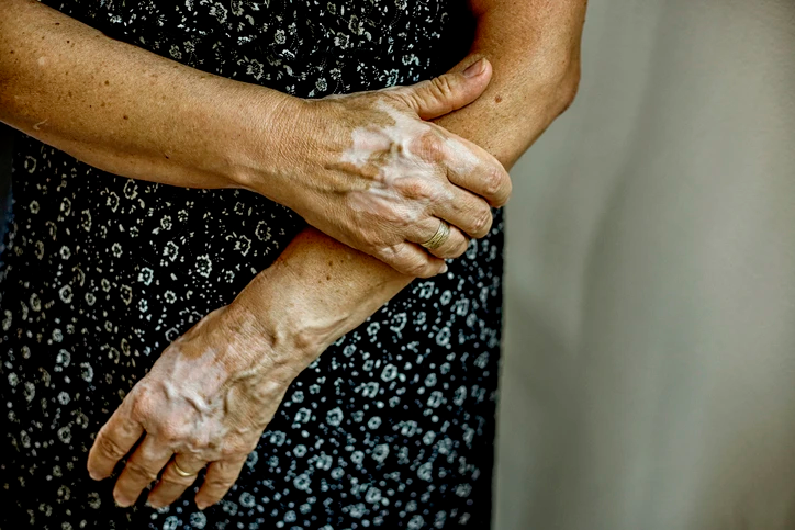 Cropped close-up shot of a woman holding her arm with one hand with vitiligo.