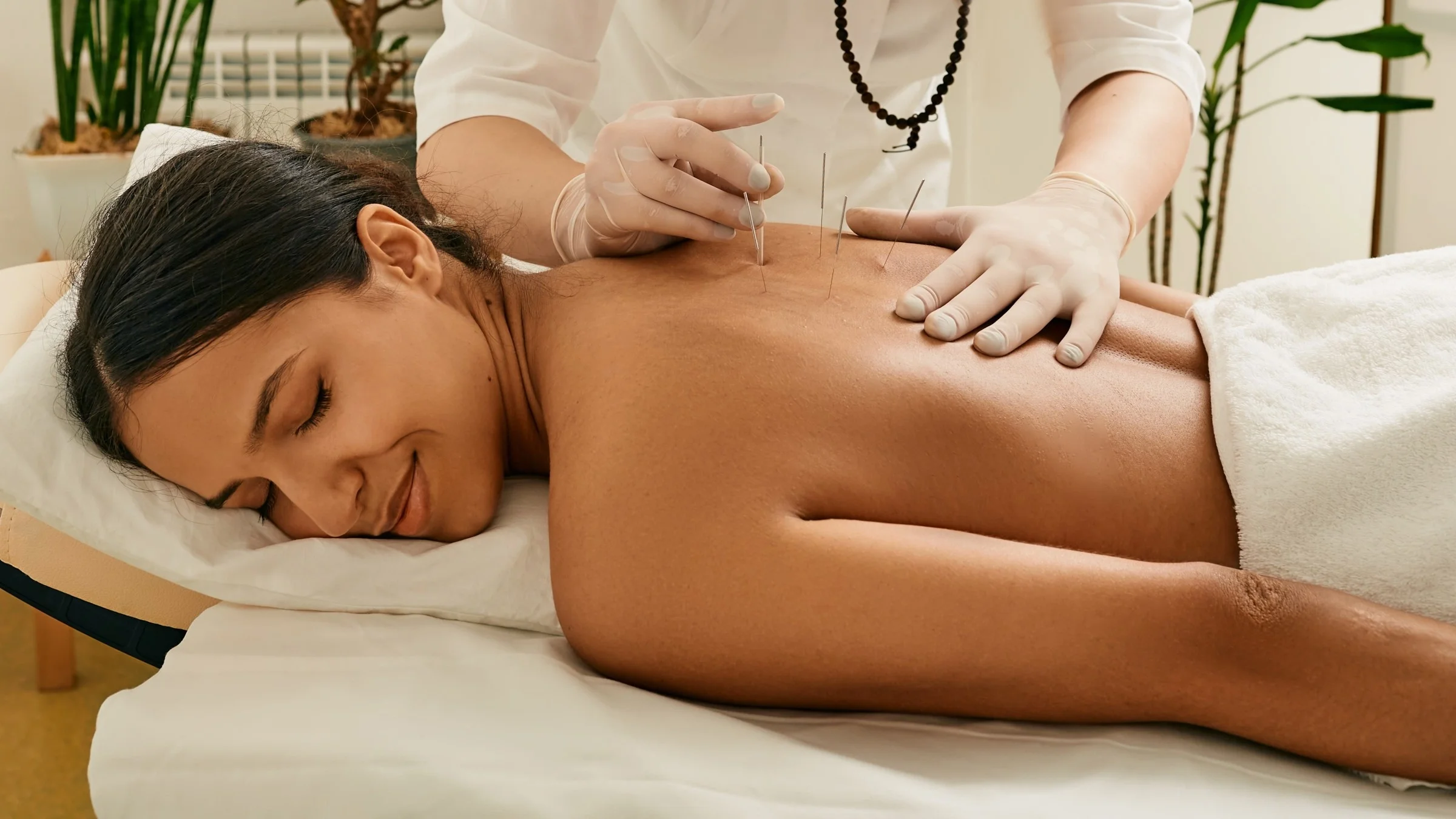 Acupuncturist placing needles on a woman’s back.