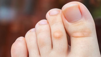 Dermatology:  closeup foot calluses 1265427298