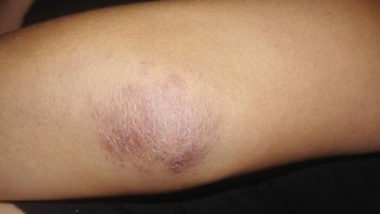 Autoimmune: Dermatology: arm with dermatomyositis