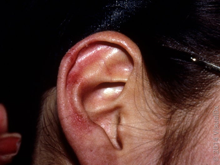 Chilblains over the external ear with crusting over one area. 