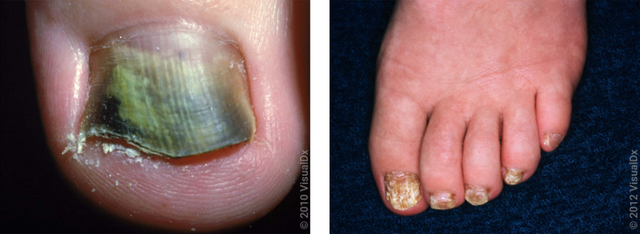 Best toenail fungus sales medicine