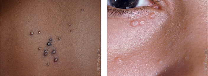 Bumps outlet on face