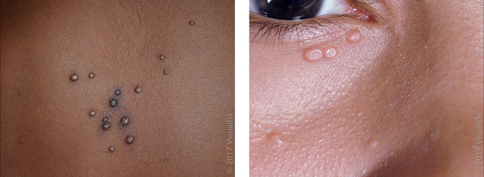Left: A cluster of several small, smooth, skin-colored bumps some surrounded by brown skin. Right: A few small, smooth, skin-colored bumps right under the lower eyelid.