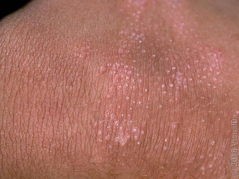 Close-up of eczema bumps on brown skin.