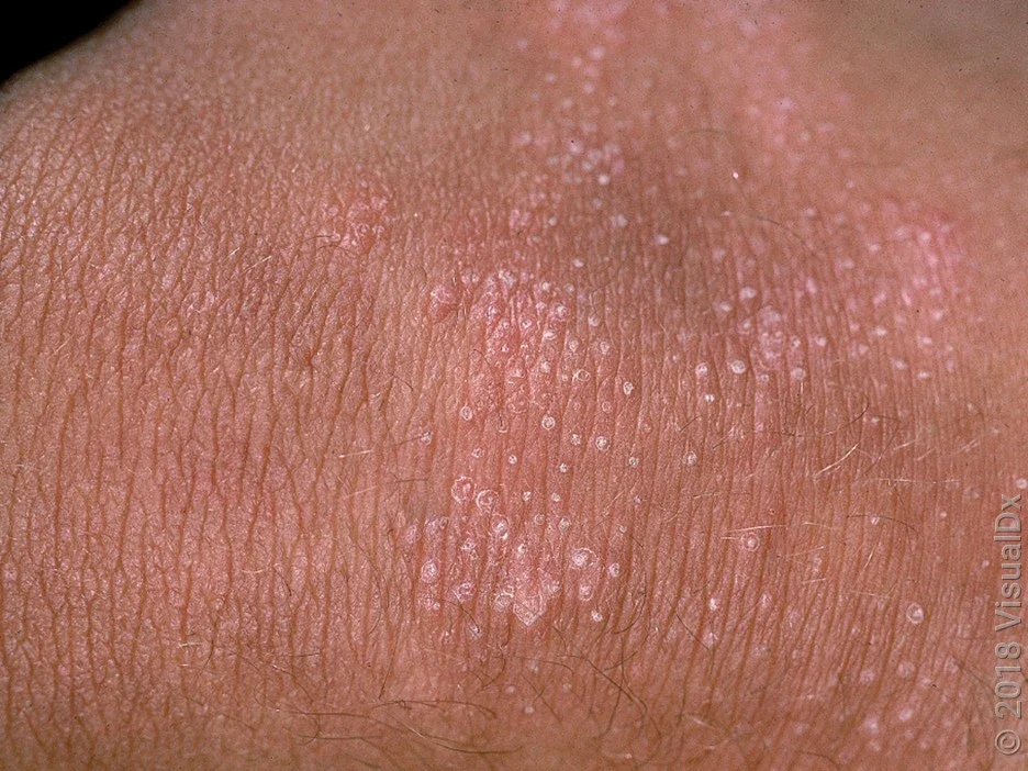 Close-up of eczema bumps on brown skin.