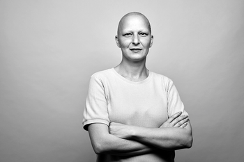 Health: Alopecia: GettyImages 1260018983