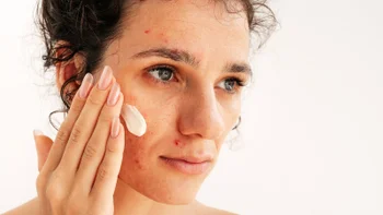 Dermatology: woman applying acne facial cream 2262578270