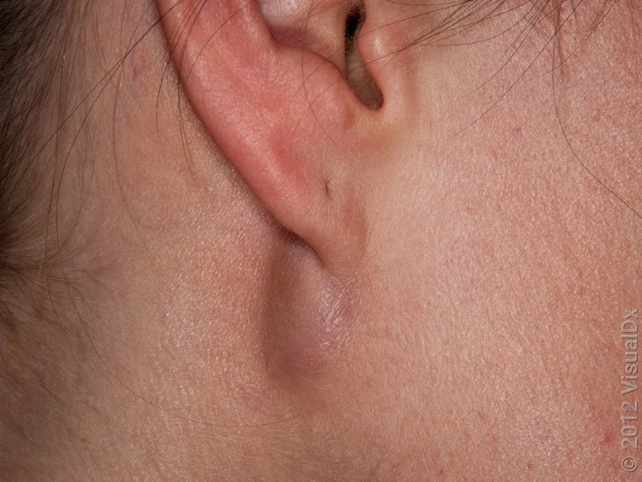 Close-up of a sebaceous cyst behind the ear. 