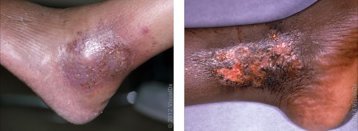 Left: The outer ankle with a patch of violet and brown discoloration that’s crusty (stasis dermatitis). Right: A brown patch of skin with a central sore (stasis dermatitis) on the leg of a person with dark skin.