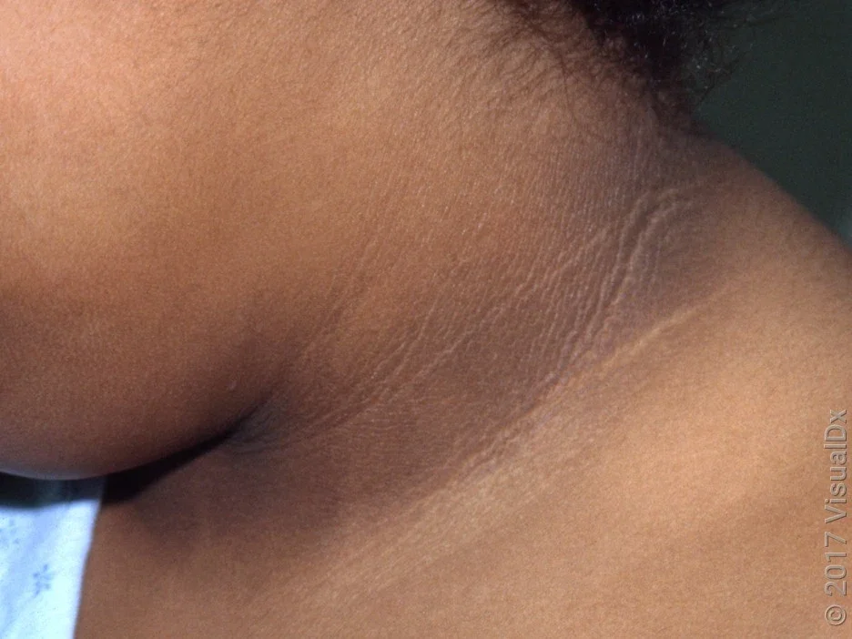 A close-up look of acanthosis nigricans on the neck. 