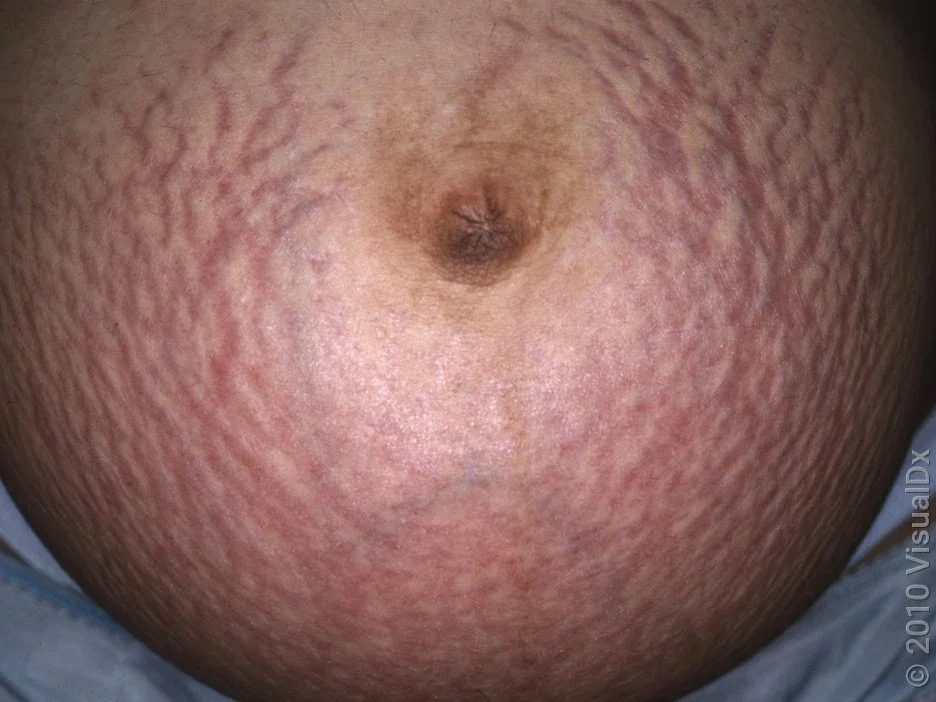 Close-up look at pregnancy stretch marks (striae gravidarum).