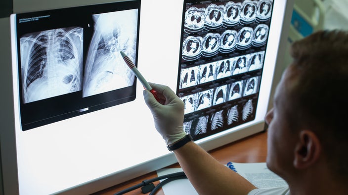 Doctor using pen to point at a portion of a chest x-ray being displaced on the light-box.
