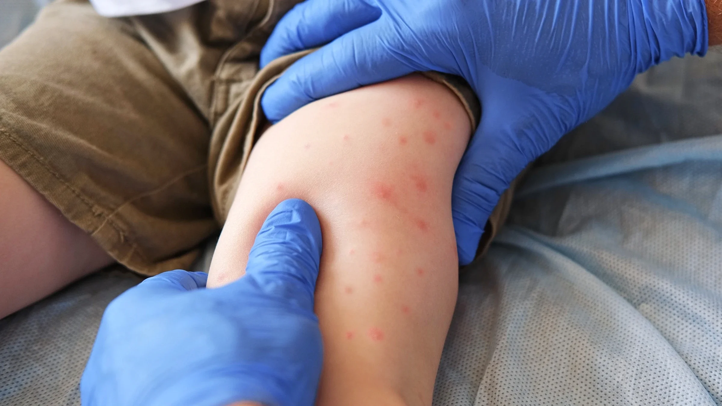 A healthcare professional examines a rash on a child’s leg.