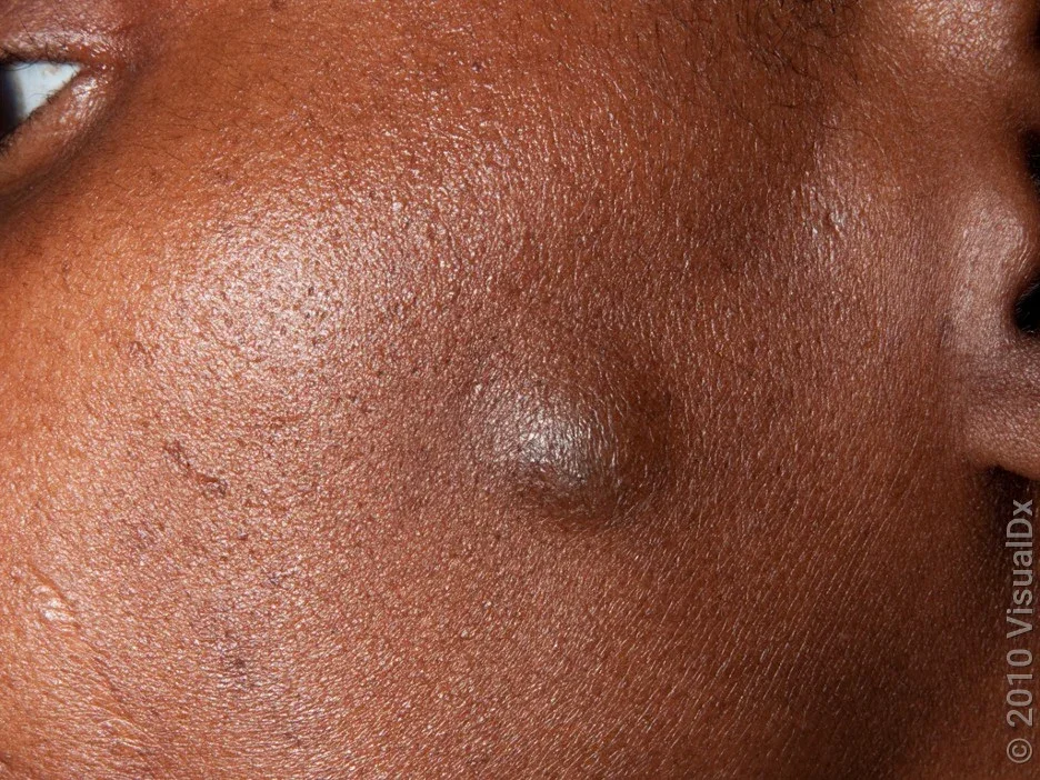 Close-up of a sebaceous cyst on the face. 