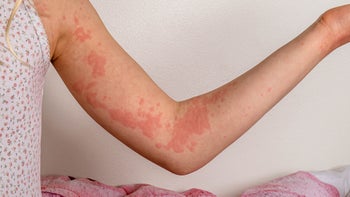 Hives: Children: hives young girls arm-1389641807