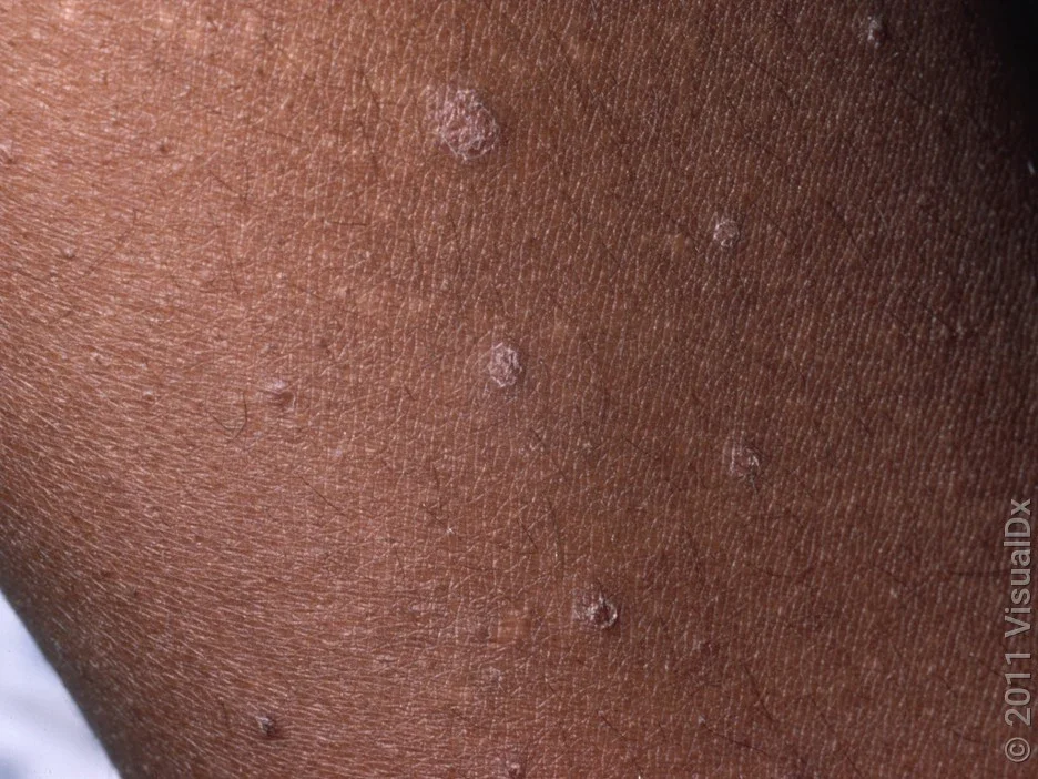 Close-up of guttate psoriasis. 