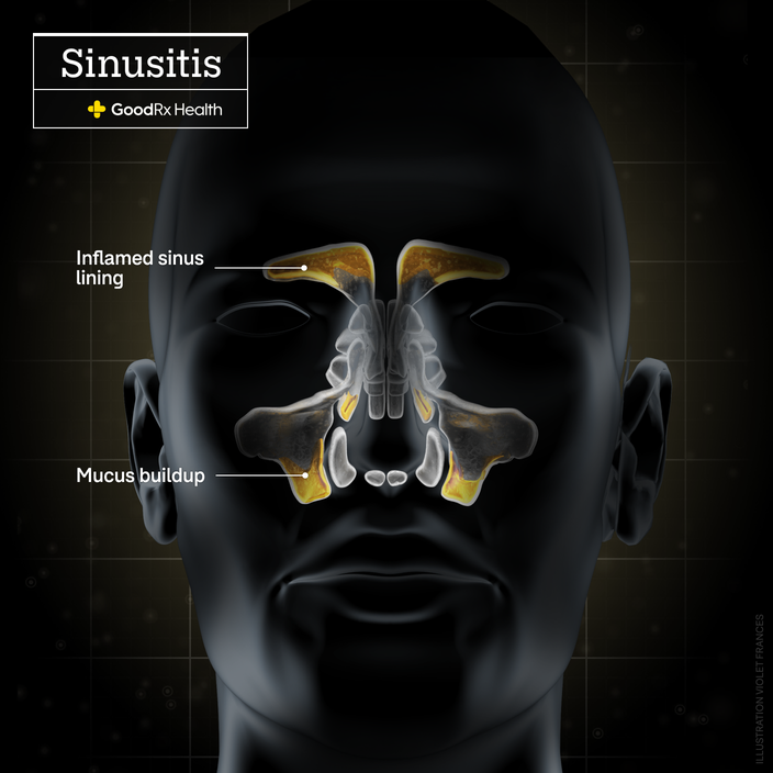 A 3D illustration of the facial sinuses with symptoms of sinusitis including inflamed sinus lining and mucus buildup.