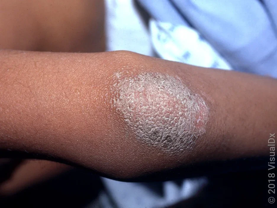 Close-up of an elbow with a pink patch with silver scale in psoriasis. 