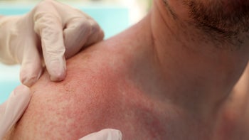 Dermatology: closeup sun damage shoulders 1368553964