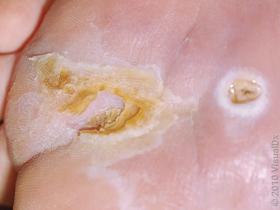 A close-up look at the early stages diabetic foot ulcer. 