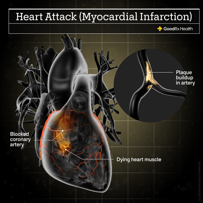 A 3D illustration of a heart attack including plaque buildup in artery, blocked coronary artery, and dying heart muscle.