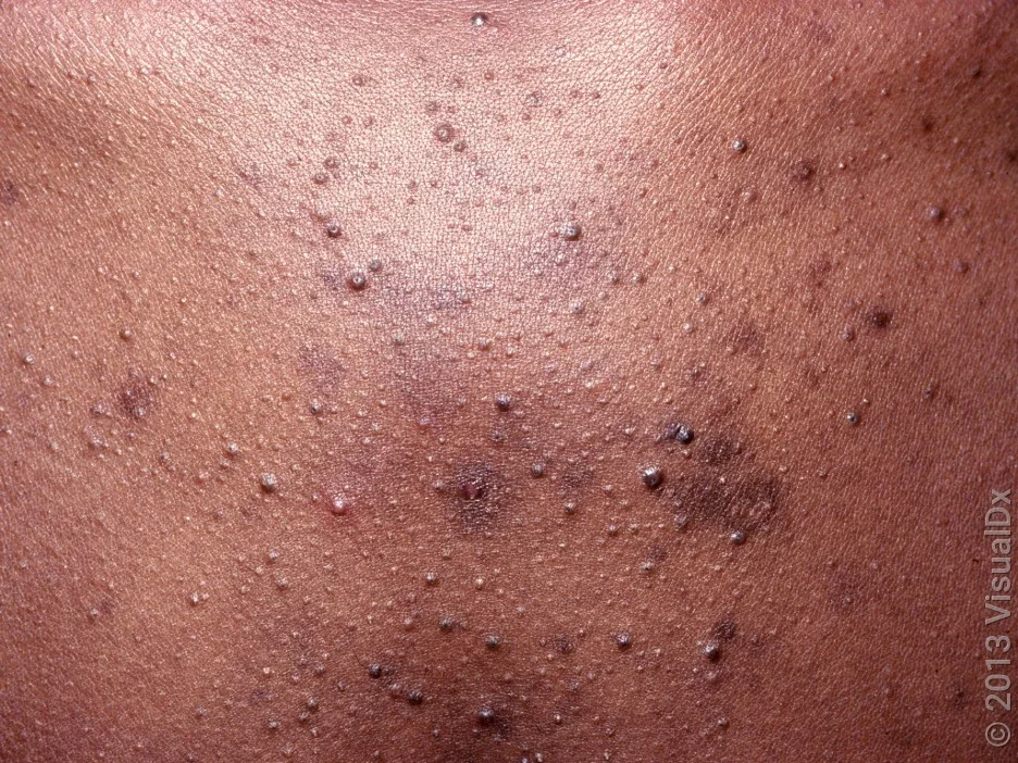 Close-up of acne on the torso. 