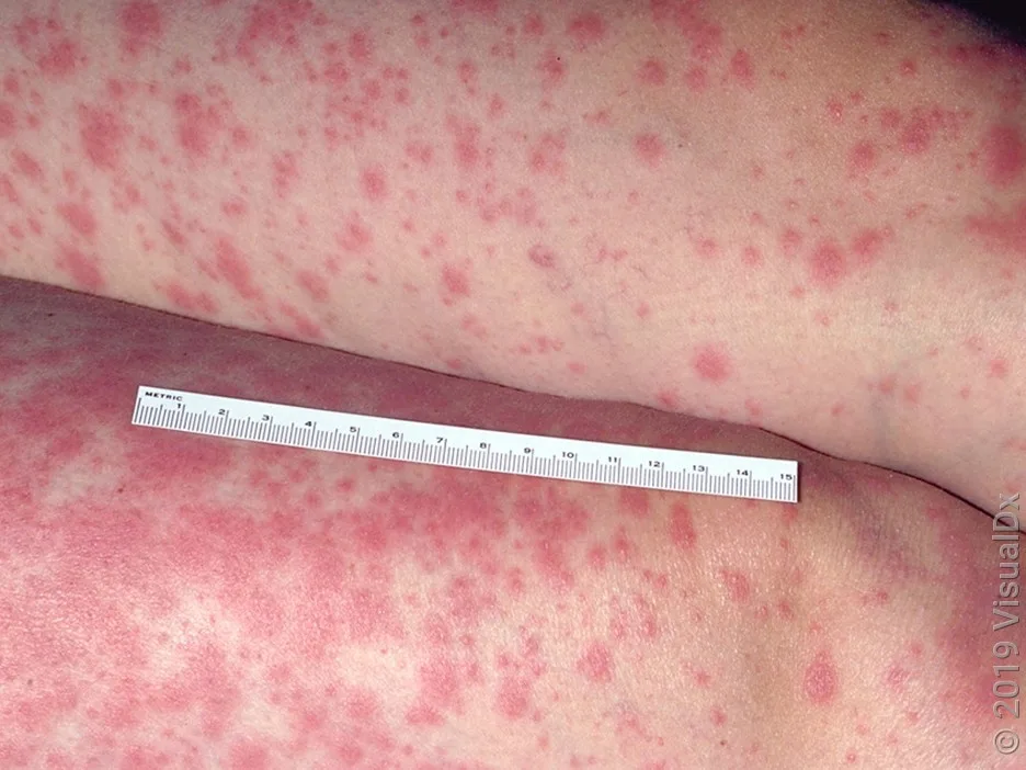 A close-up look of a person’s legs with red patches caused by SJS.