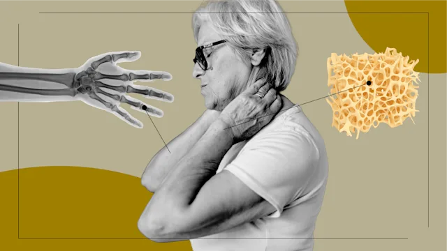 Patient experiences: patient stories feel osteoporosis option 2