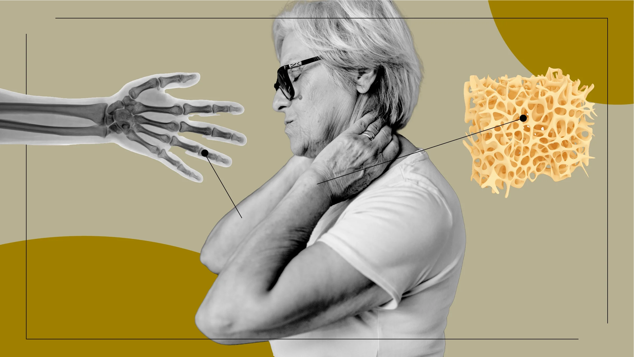 Light-tan background with a black-and-white cutout of an older woman rubbing her neck. Off of her are diagram lines pointing to objects representing osteoporosis. On the left is an X-ray of a wrist. On the right is a bone density cross section. 