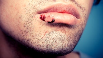 Health: Oral: closeup lip cold sore bleeding man with stubble-498976783