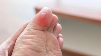 Dermatology: closeup blister on toe 1444042068