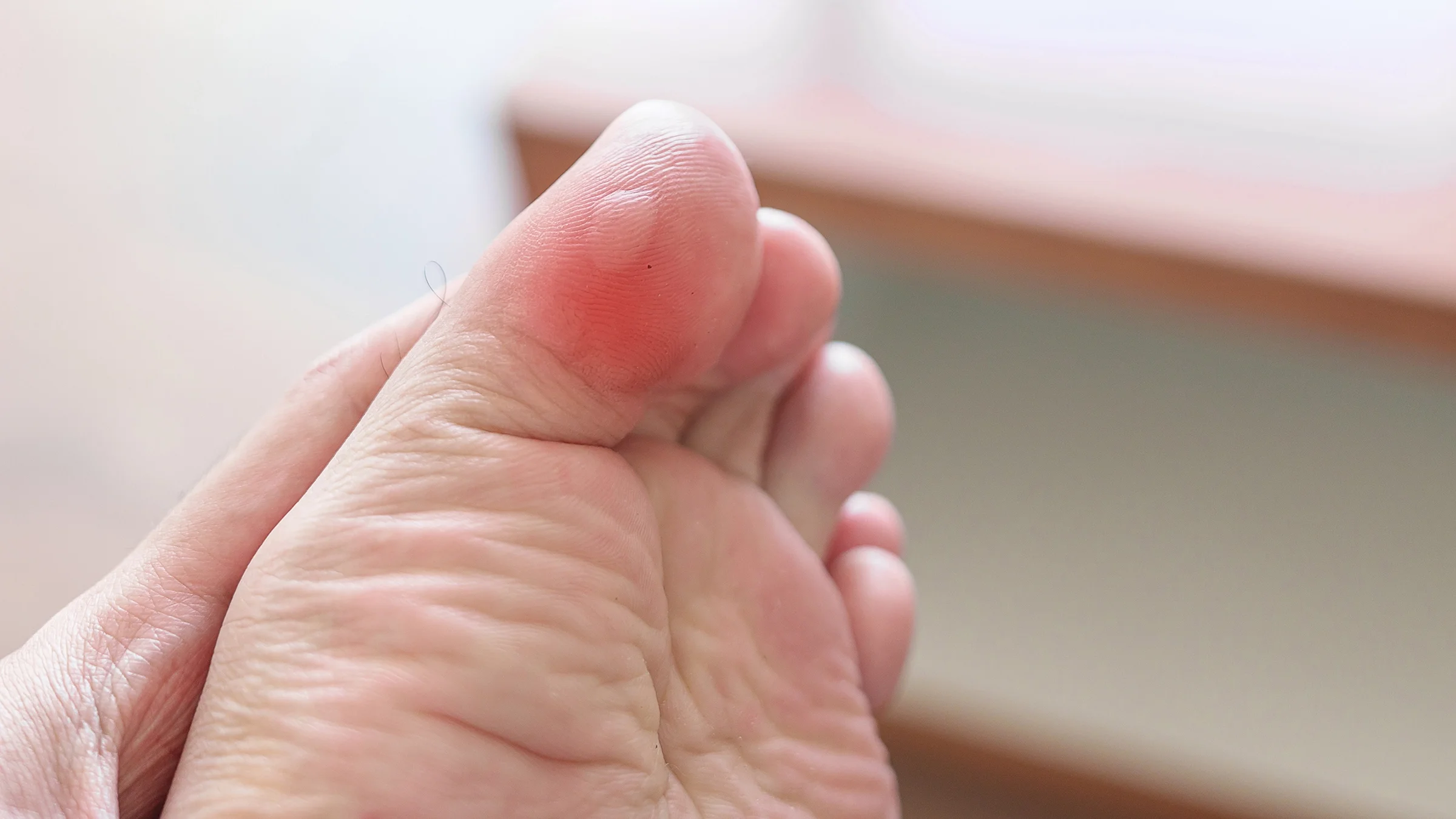 A person has a blister on their toe.