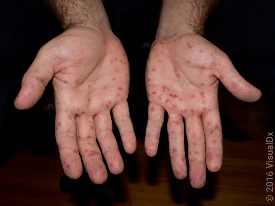 Palms with many spots caused by hand, foot, and mouth disease.