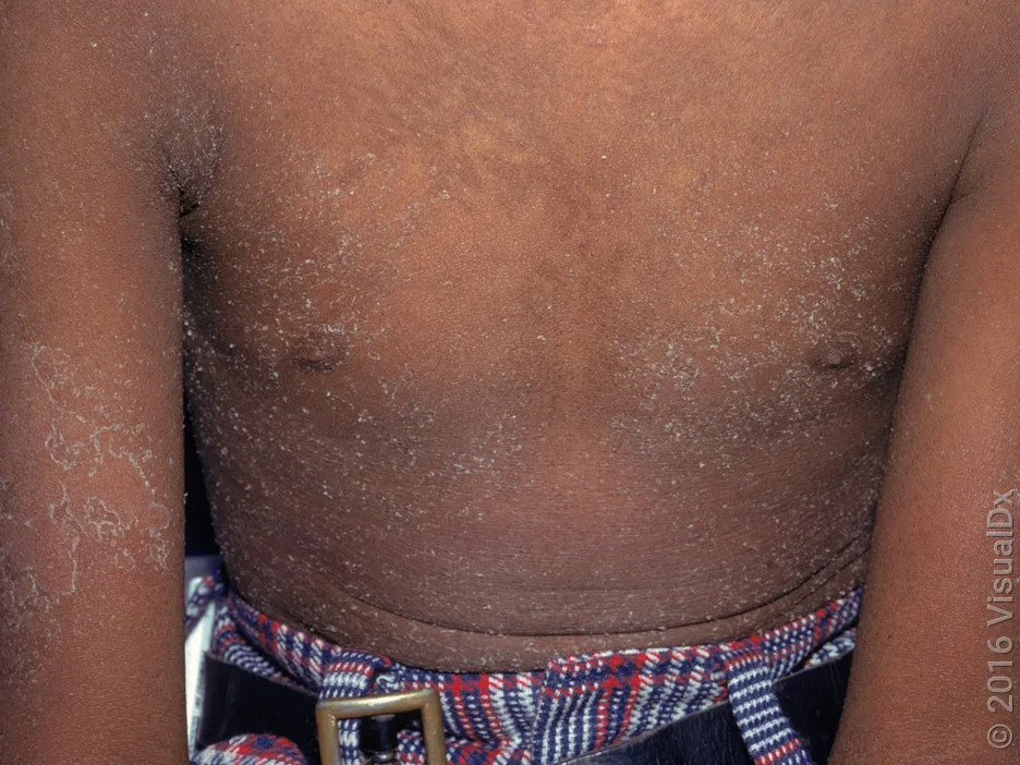 Close-up of a chest and arms with skin peeling from scarlet fever.