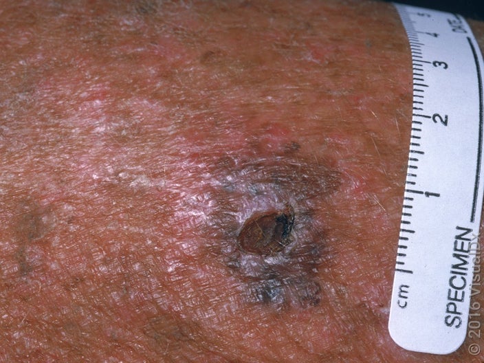 Close-up of a melanoma on dark skin. 