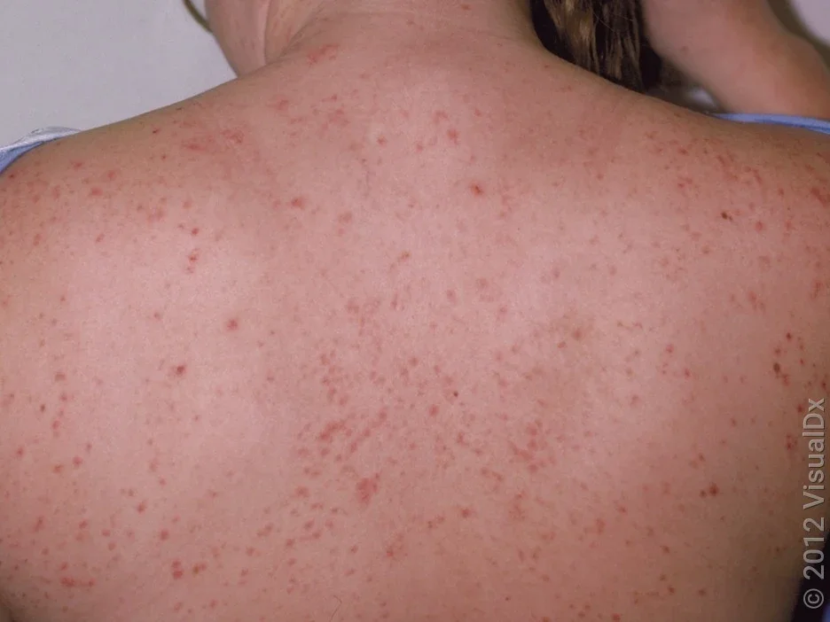 Close-up of guttate psoriasis on the back. 