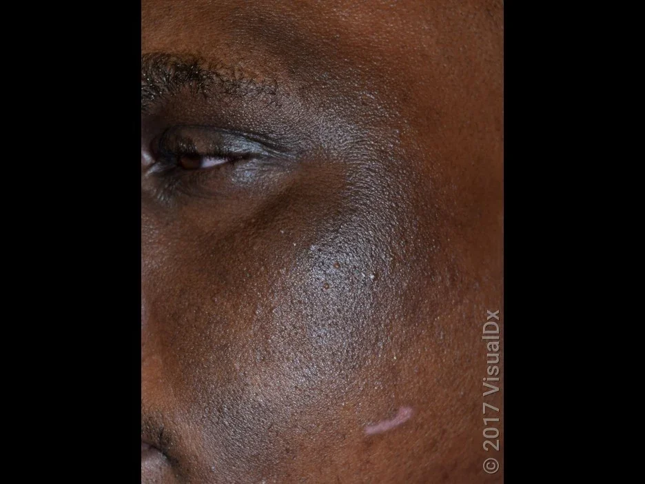 Close-up of facial eczema on darker skin tone.