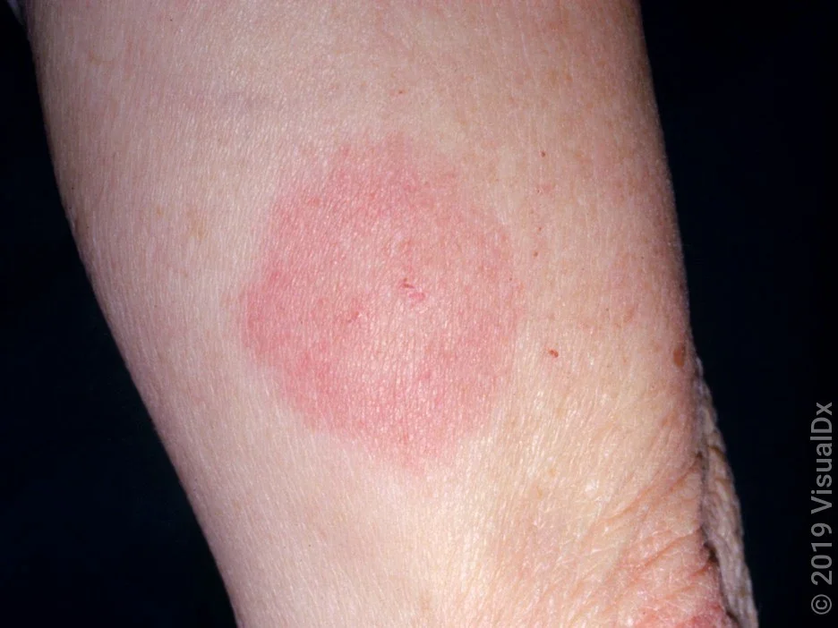 Ring-shaped rash on the skin, from Lyme disease.