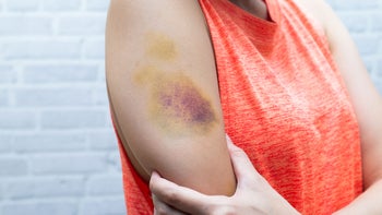 Dermatology: Itchy bruise: close up woman bruise 1059076258