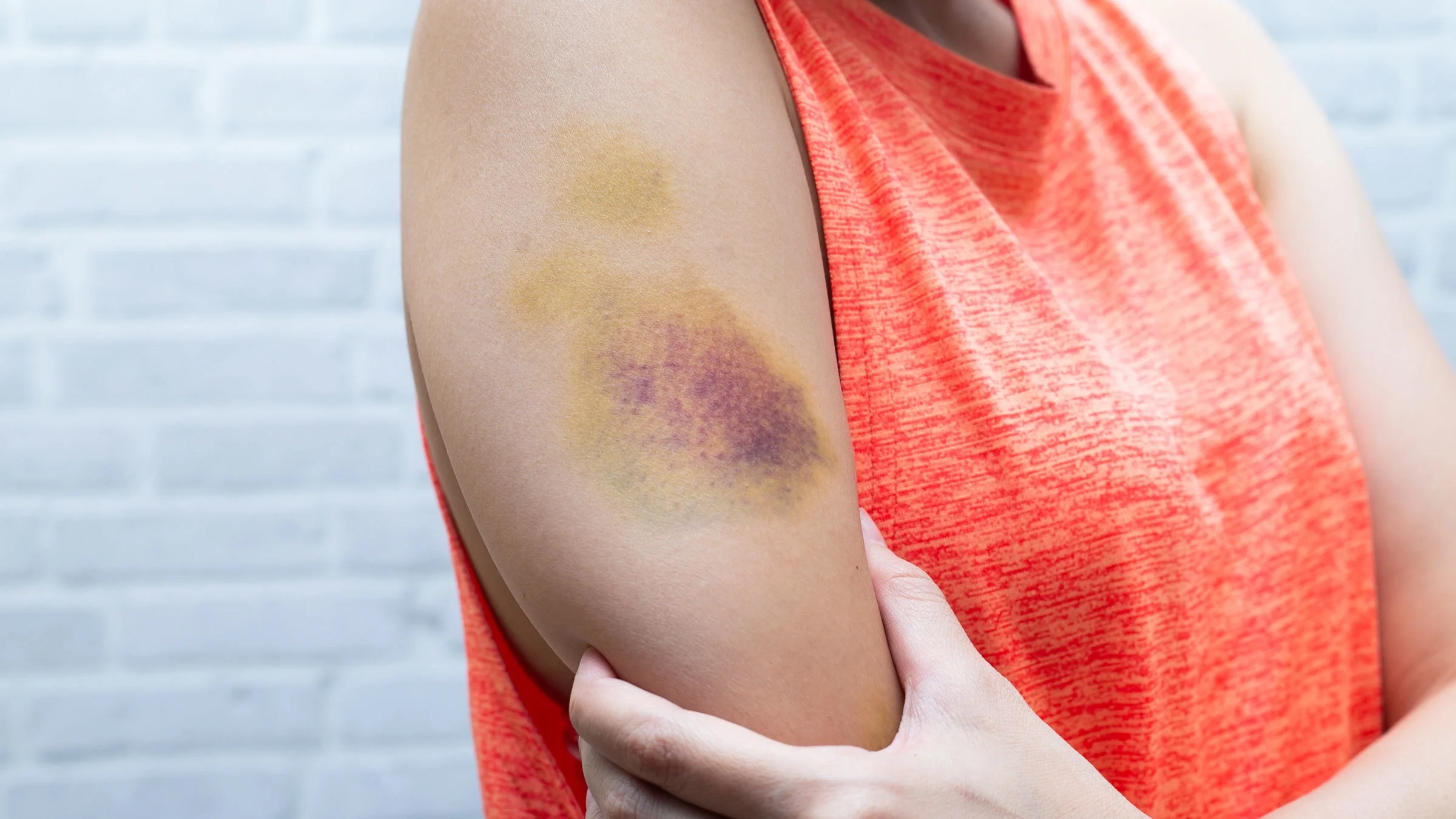 A close-up photo shows an adult with a bruise on their arm.